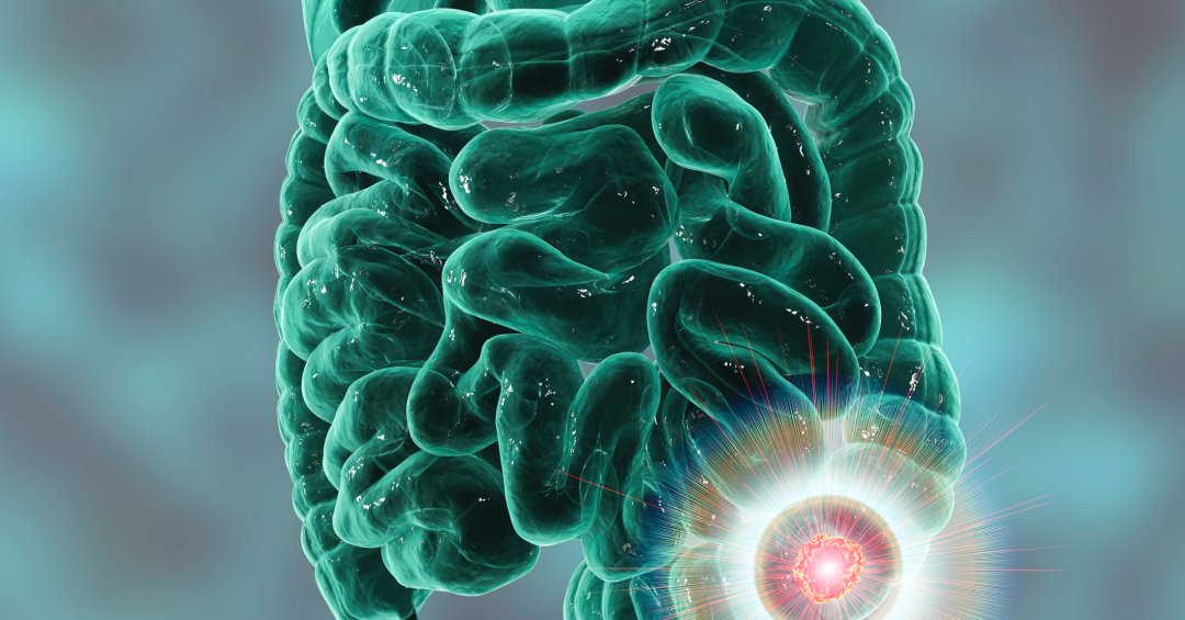 Março Azul: conexão entre obesidade, diabetes e câncer de intestino