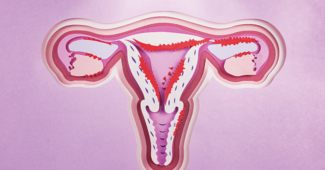 Endometriose no Brasil: Diagnóstico Tardio e Desafios no Acesso à Saúde